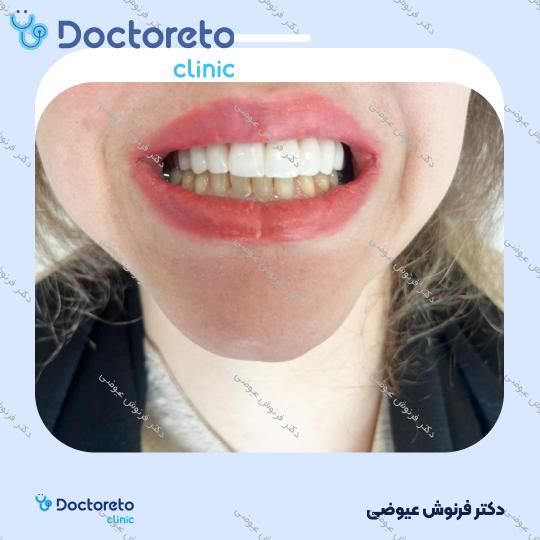 روکش سرامیکی دندان زیرکونیا (هر واحد)