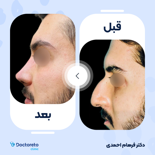 عمل جراحی مجدد زیبایی بینی (رینوپلاستی)