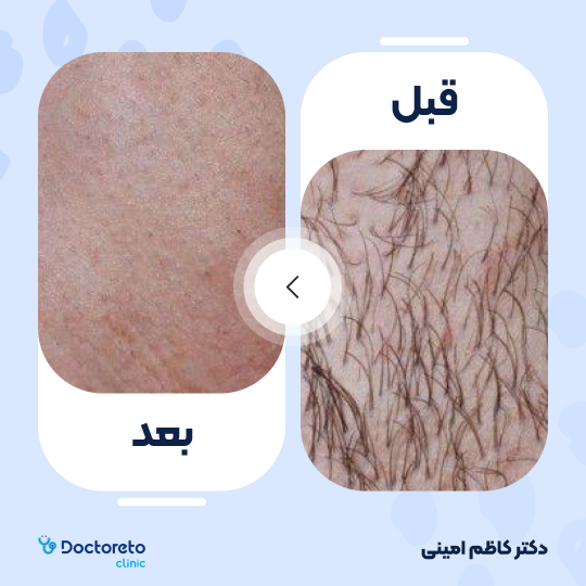 لیزر موهای زائد خانم ها (بیکینی) با دستگاه جونولوکس کره ای