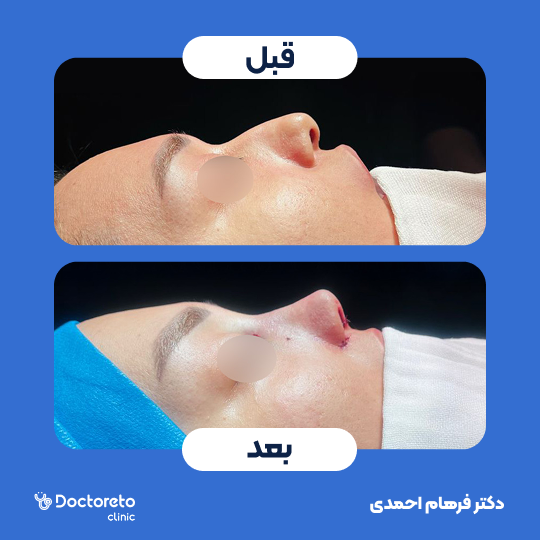 عمل زیبایی بینی (رینوپلاستی)