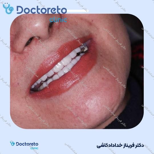 لمینت سرامیکی ایمکس آلمان به همراه تکسچر (هر واحد)