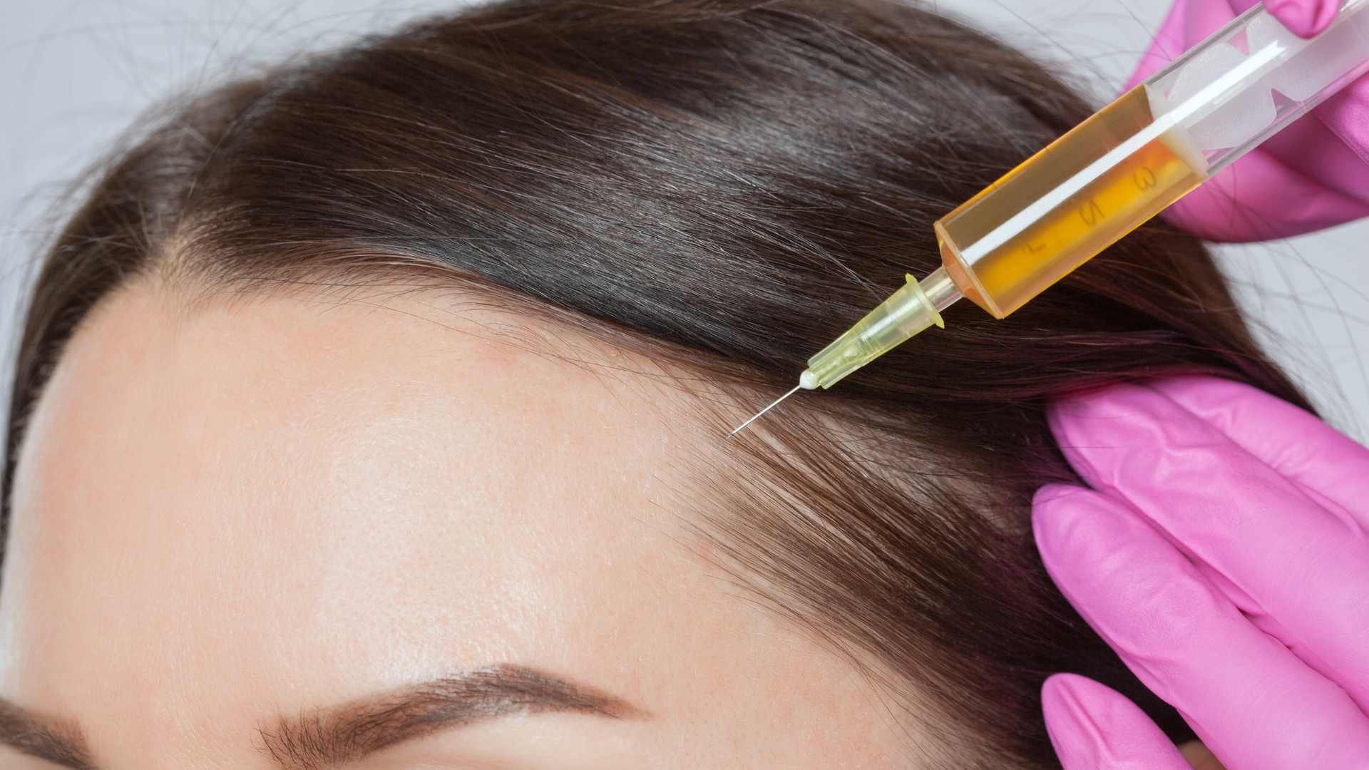 مزوتراپی مو سر با برند مرولایک اسپانیا (هر جلسه)