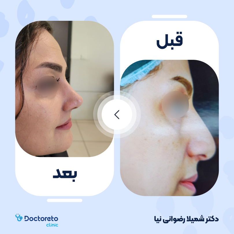 عمل زیبایی بینی گوشتی (رینوپلاستی) دکتر شمیلا رضوانی نیا در شیراز 7