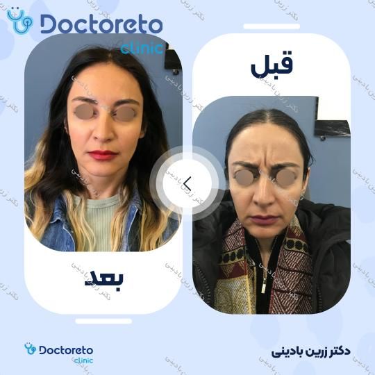 بوتاکس صورت (پیشانی، پنجه کلاغی، خط اخم، ) با برند مصپورت