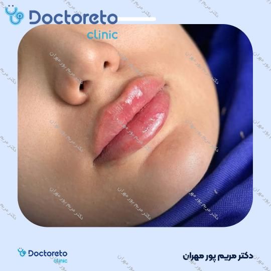 تزریق ژل لب با برند نورامیس (1cc) دکتر مریم پور مهران در شیراز 2