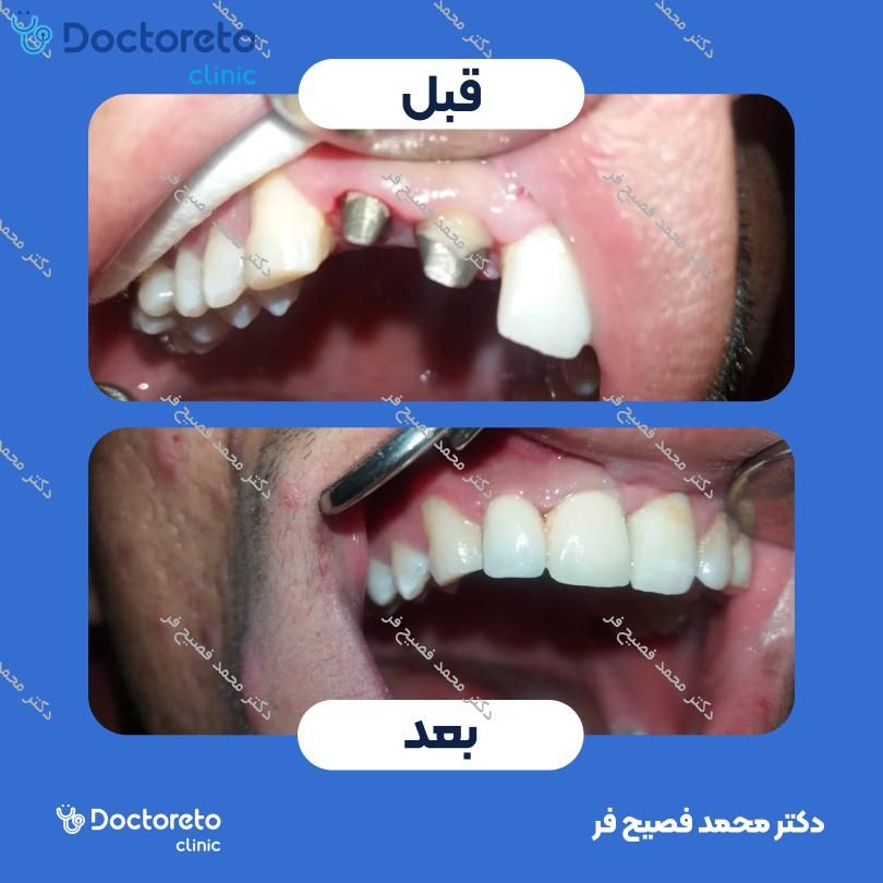 روکش دندان PFM (هر واحد)