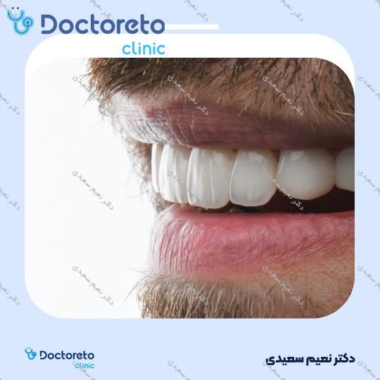 لمینت آی پی اس ایمکس (هر واحد)