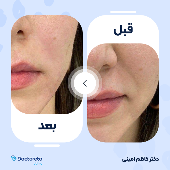 جوانسازی صورت با اگزوزوم تراپی و پلاسماتراپی (هر جلسه)