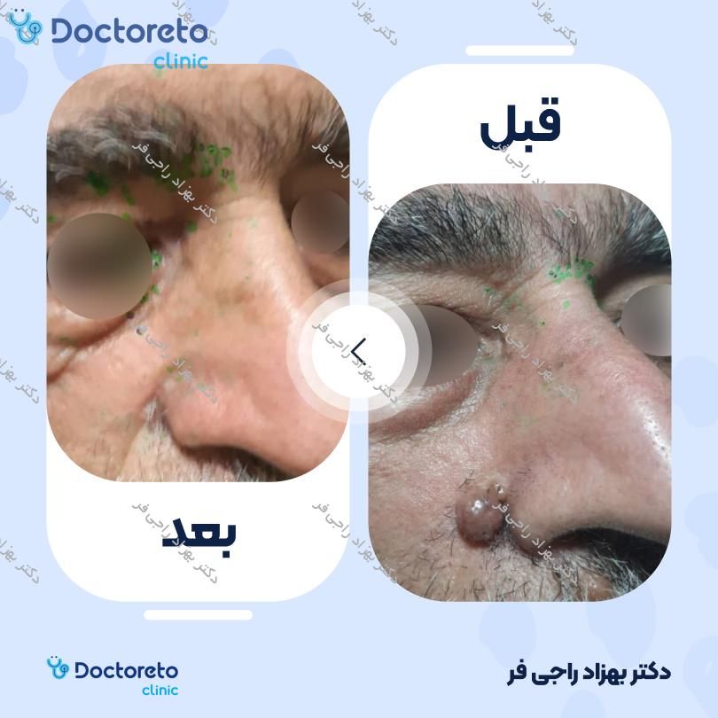 برداشتن خال صورت با دستگاه CO2 (سایز کوچک)