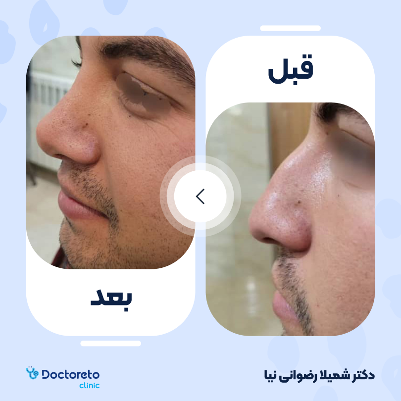 عمل زیبایی بینی گوشتی (رینوپلاستی) دکتر شمیلا رضوانی نیا در شیراز 3