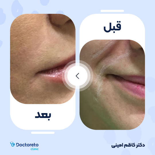 جوانسازی صورت با اگزوزوم تراپی و پلاسماتراپی (هر جلسه)