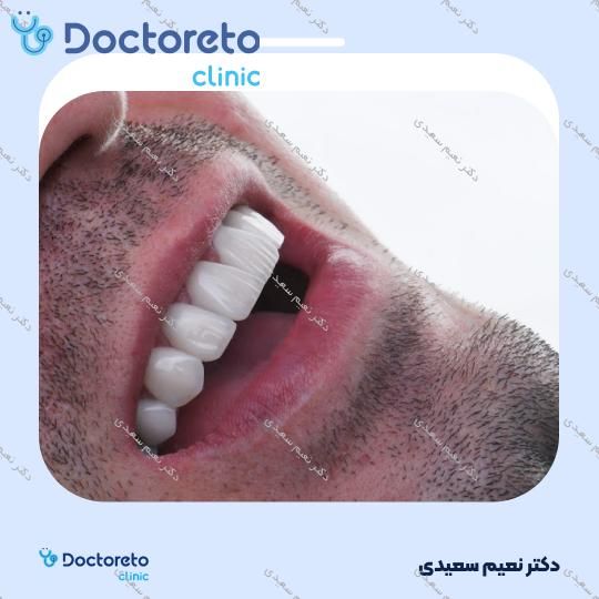 لمینت آی پی اس ایمکس (هر واحد)