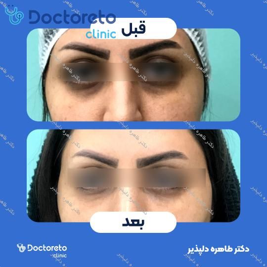 تریق ژل زیر چشم با برند اینوسنس (1CC) دکتر طاهره دلپذیر در شیراز 9