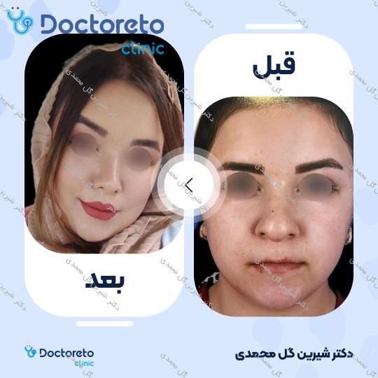 عمل جراحی بینی (رینوپلاستی)