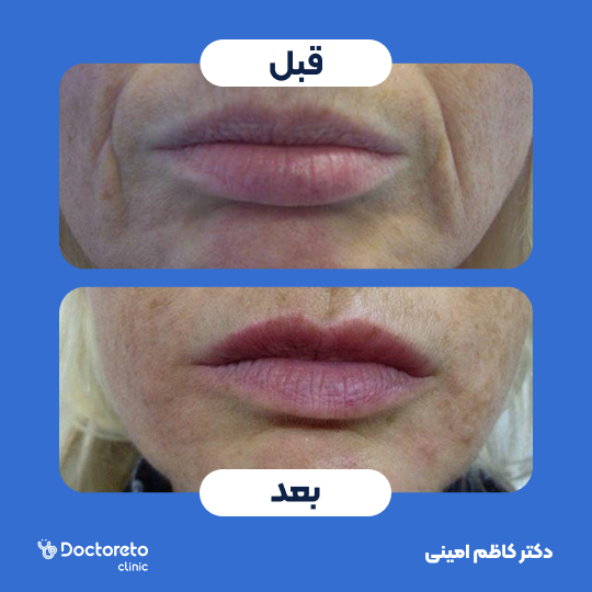 جوانسازی صورت با اگزوزوم تراپی و پلاسماتراپی (هر جلسه)