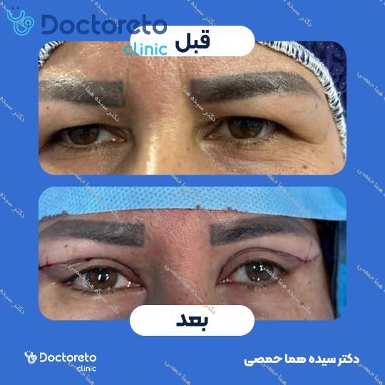بلفاروپلاستی پلک بالا و پلک پایین به روش جراحی