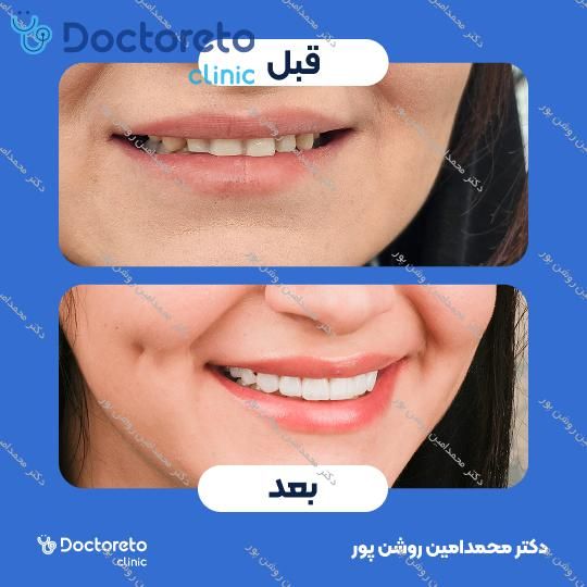 لمینت سرامیکی ایمکس (هر واحد)