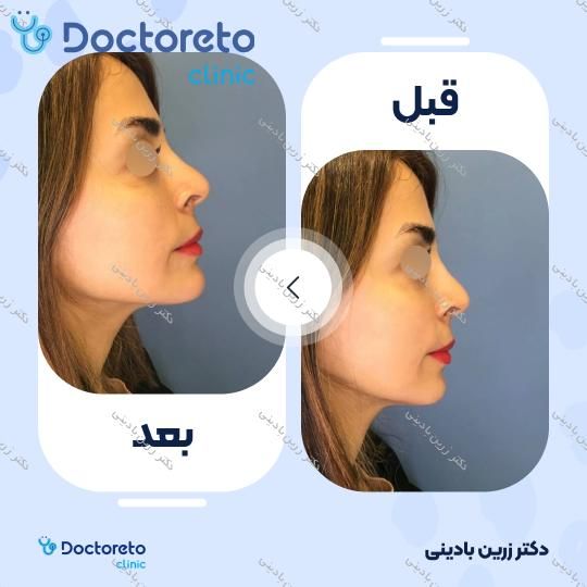 تزریق ژل چانه با برند فیوریج (1cc)