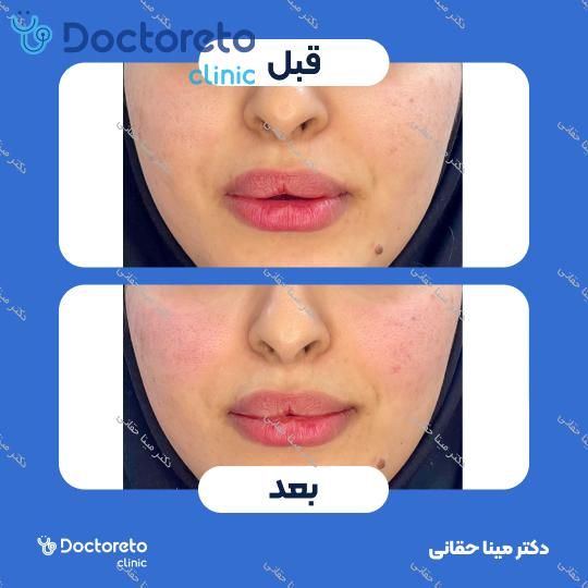 تزریق ژل گونه با برند نئوویا (1CC) دکتر مینا حقانی در اصفهان 14