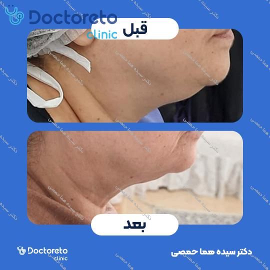 رفع غبغب به روش ساکشن