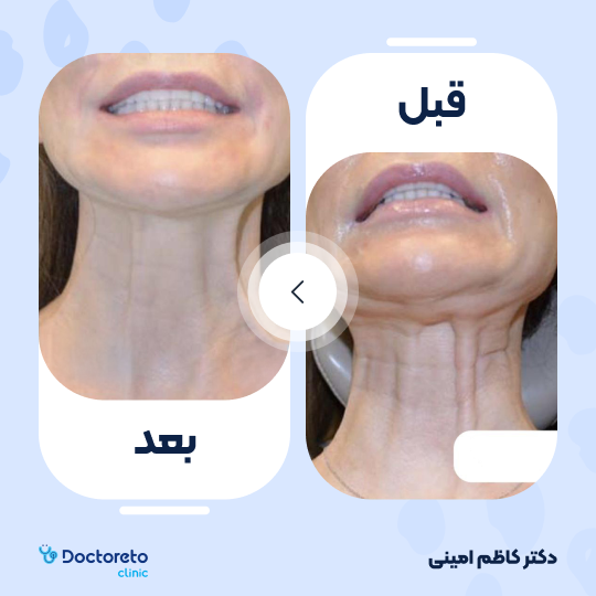 جوانسازی صورت با اگزوزوم تراپی و پلاسماتراپی (هر جلسه)