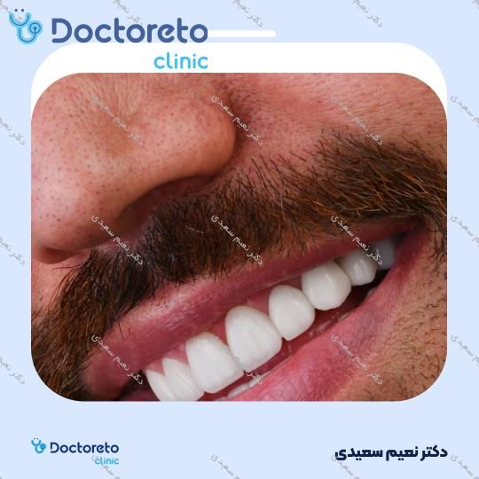 لمینت آی پی اس ایمکس (هر واحد)
