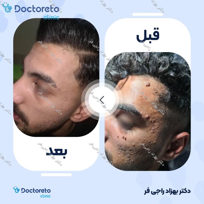 درمان زگیل صورت آقایان با روش لیزر co2 (هر عدد)
