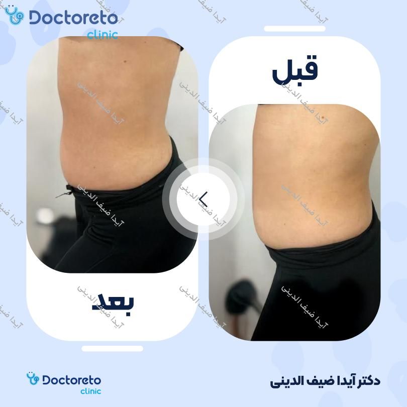 لاغری موضعی (شکم) با دستگاه کویتیشن (بانوان)(هرجلسه)