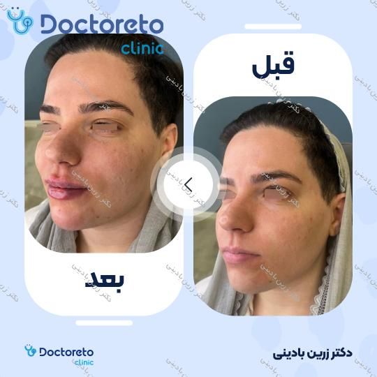 تزریق ژل چانه با برند فیوریج (1cc)