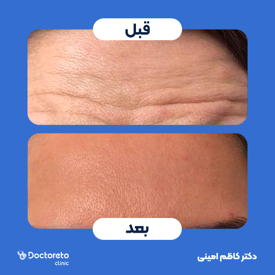 تزریق بوتاکس صورت (پیشانی) با برند مصپورت