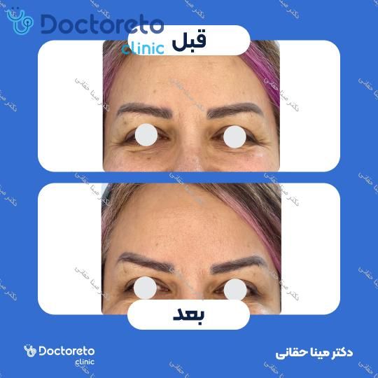 تزریق بوتاکس صورت (پیشانی، خط اخم، پنجه کلاغی) با برند مصپورت دکتر مینا حقانی در اصفهان 10