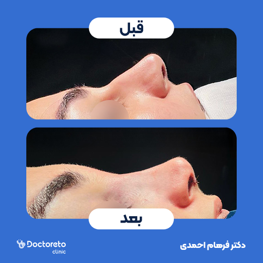 عمل زیبایی بینی (رینوپلاستی)