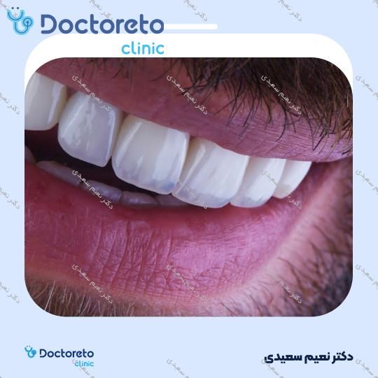 لمینت آی پی اس ایمکس (هر واحد)
