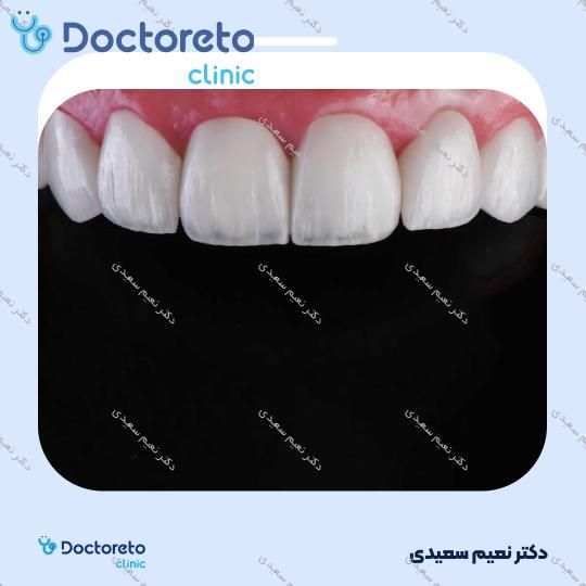 لمینت آی پی اس ایمکس (هر واحد)