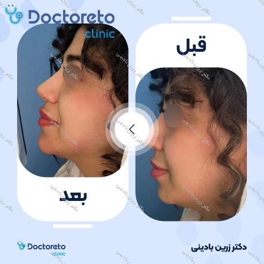 تزریق ژل چانه با برند فیوریج (1cc)