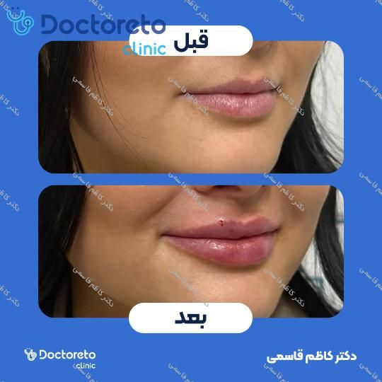 تزریق ژل لب با برند رووفیل (1cc)