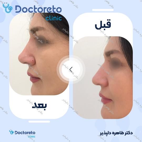 تزریق ژل بینی با برند روولاکس (1cc)
