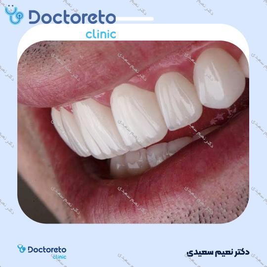 لمینت آی پی اس ایمکس (هر واحد)