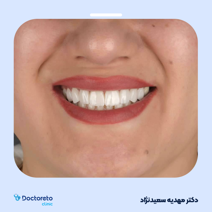 لمینت سرامیکی ایمکس آلمانی (هر واحد)