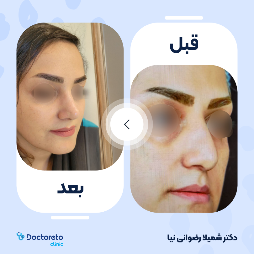 عمل زیبایی بینی گوشتی (رینوپلاستی) دکتر شمیلا رضوانی نیا در شیراز 6