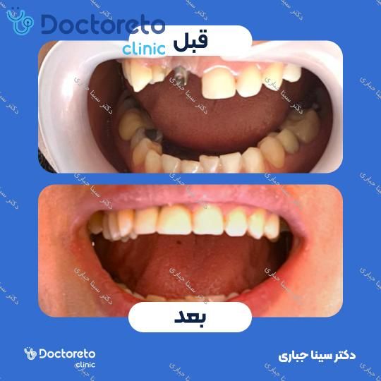 روکش تمام سرامیک زیرکونیا (هر واحد)