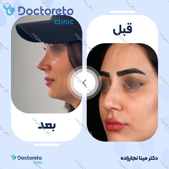 عمل زیبایی بینی (رینوپلاستی)