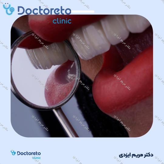 لمینت سرامیکی ایمکس آلمان (هر واحد)