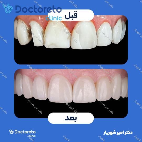ایمپلنت spi سوئیسی با روکش (هر واحد)
