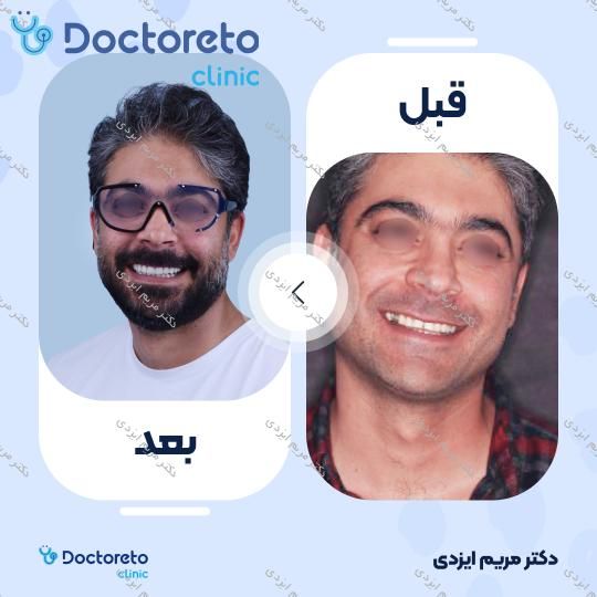 لمینت سرامیکی ایمکس آلمان (هر واحد)