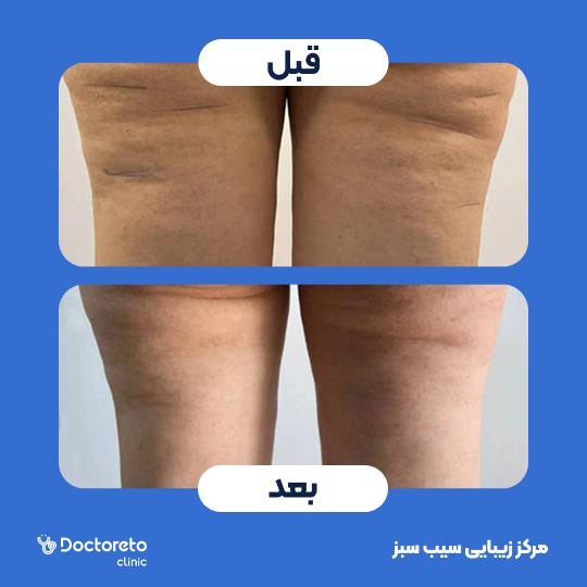 پکیج لاغری موضعی با دستگاه و رژیم تغذیه لاغری (8 جلسه)
