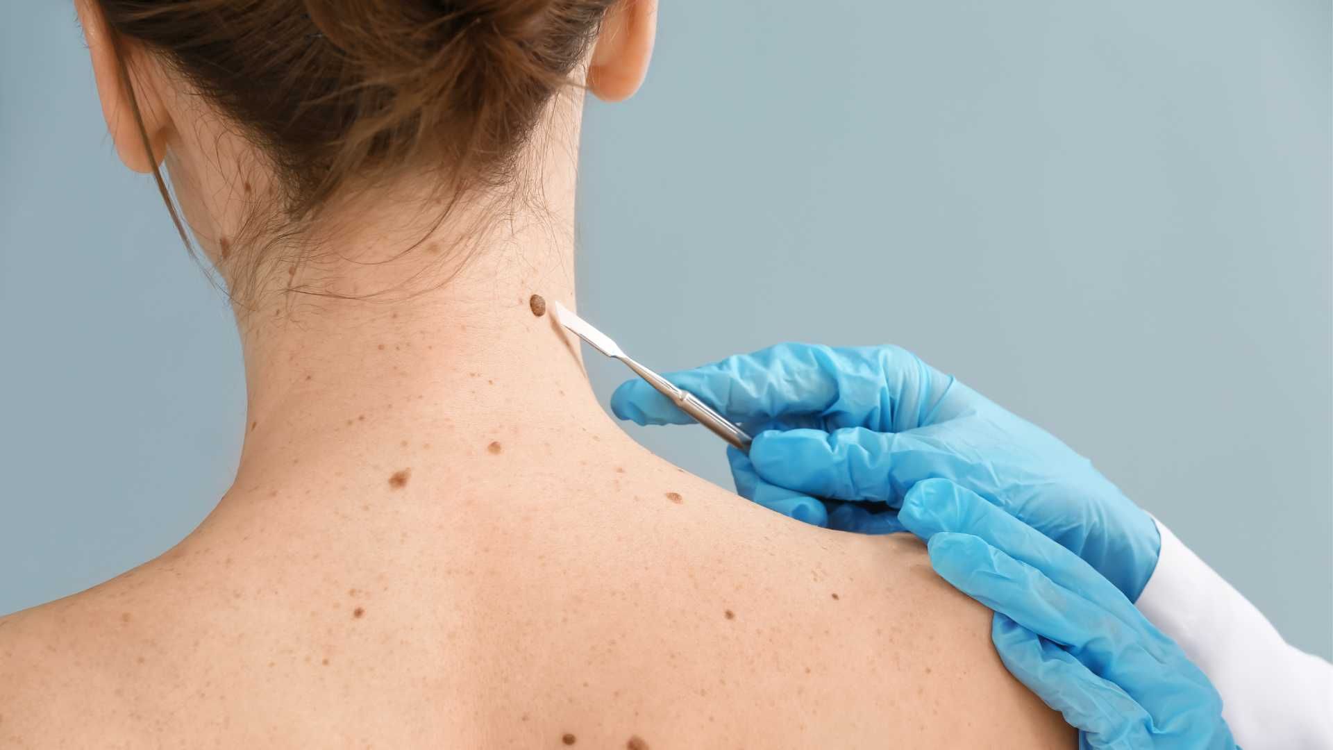 برداشتن خال کوچک با لیزر RF سرجیکال (هر عدد)