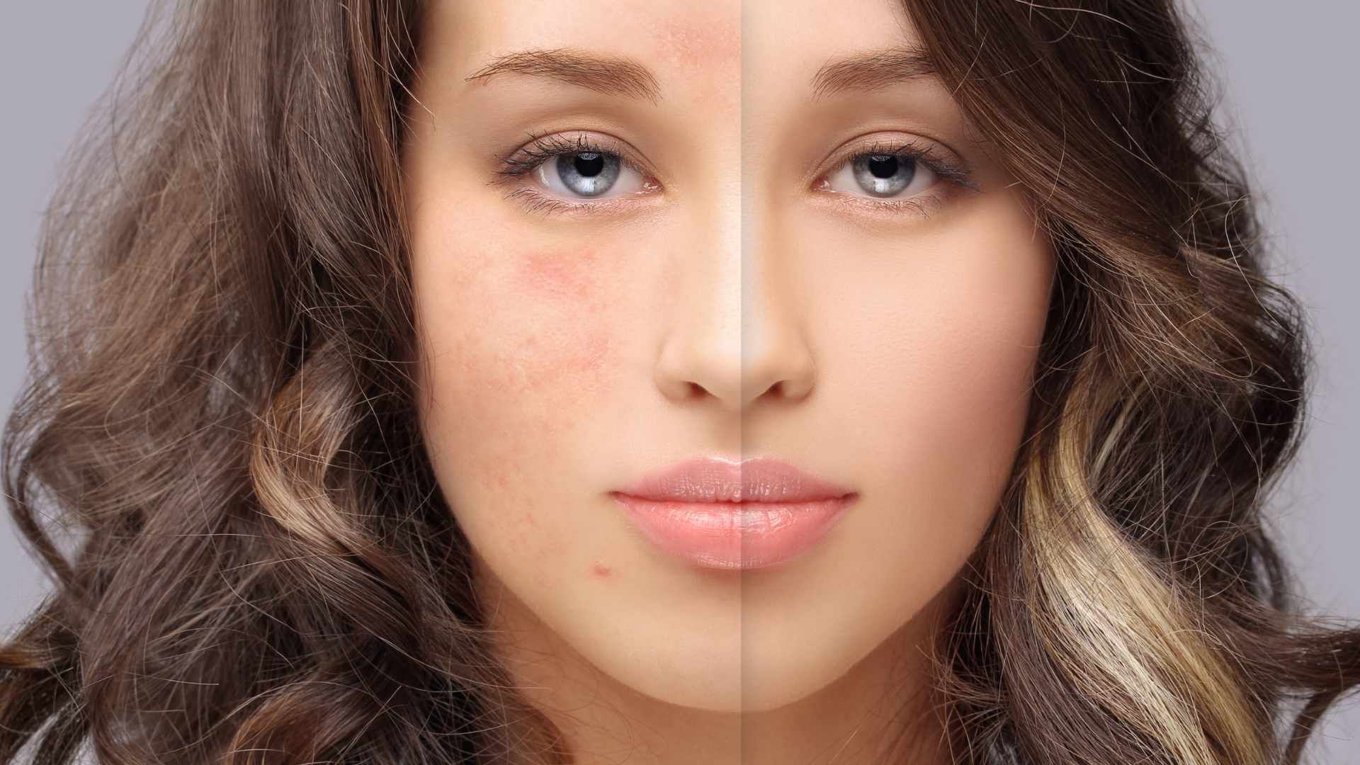رفع جای جوش، اسکار و چین و چروک با لیزر RF فرکشنال (هر جلسه)