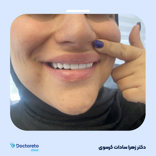 لمینت ایمکس vip (هر واحد)