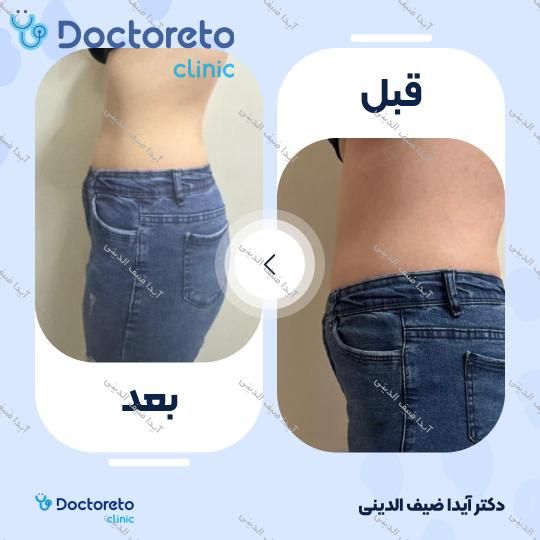 لاغری موضعی (شکم) با دستگاه کویتیشن (بانوان)(هرجلسه)
